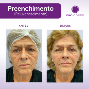 Preenchimento Bigode Chines Antes e Depois